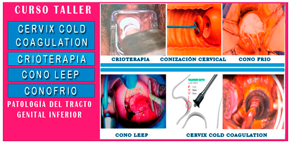 Curso Procedimientos en Lesiones Pre-malignas Cuello Uterino: ConoLeep, Conofrío, Crioterapia y Cold Coagulation
